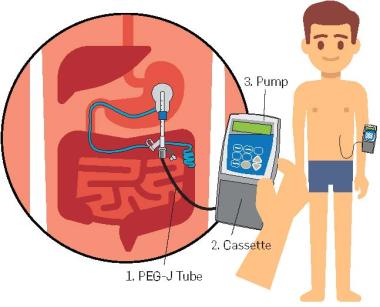 Infographic showing duopa components