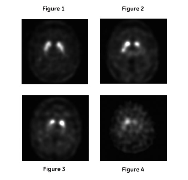 Four images of a brain via DaTscan. Figure 1 shows a scan image of a healthy brain. By comparison, Figures 2 through 4 are examples of abnormal scans that could show brain degeneration, which is consistent with a diagnosis of Parkinsonian syndrome.