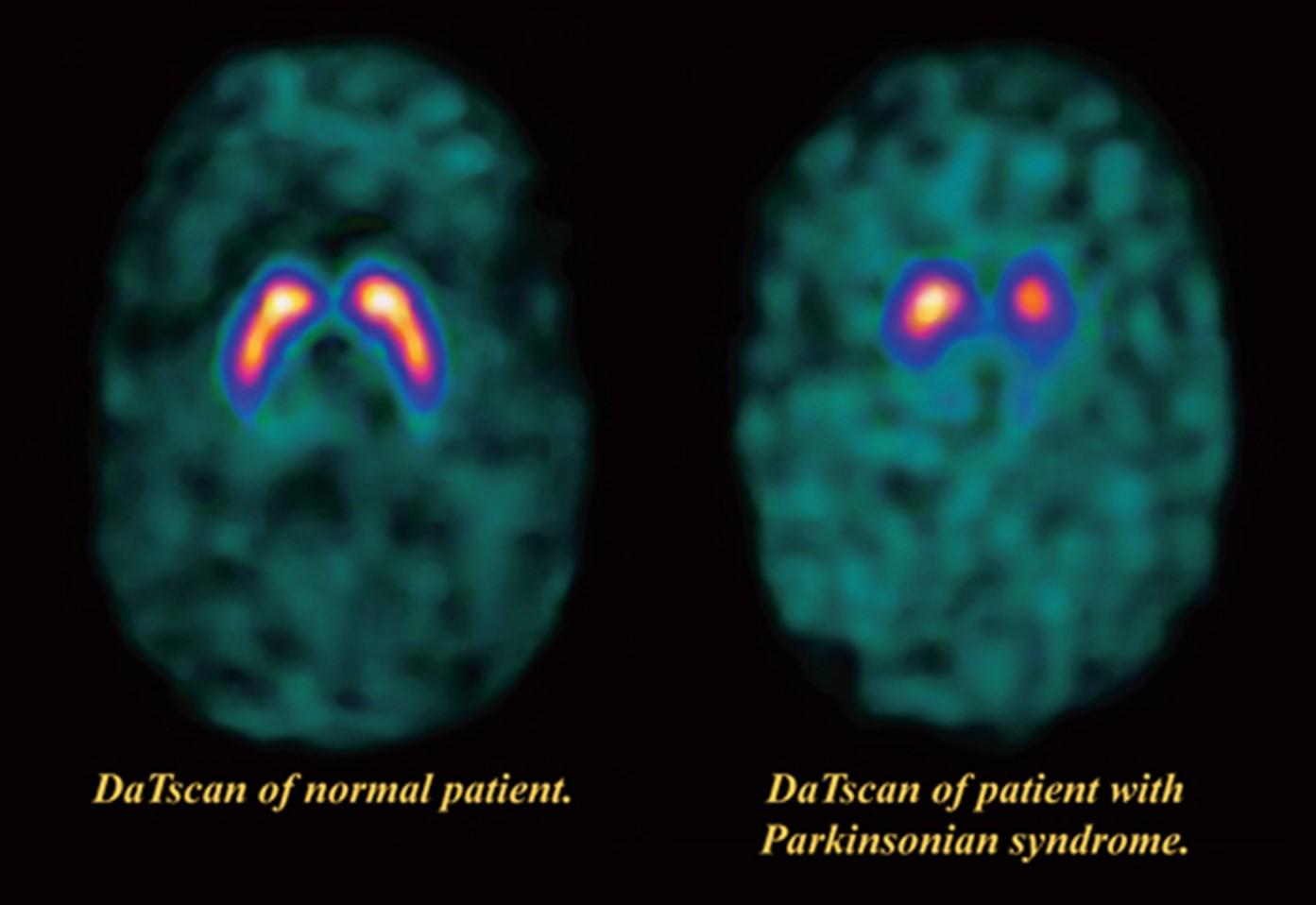 DaTscan imagery comparing the DaTscan of a normal patient with that of a patient with Parkinson's disease. 