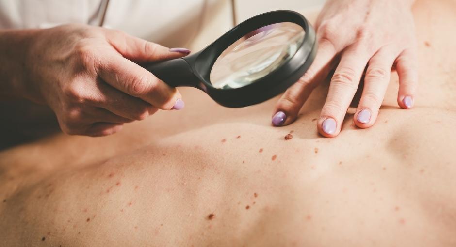 Doctor checking patient's back for melanoma