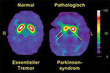 Top 20+ how is parkinsons diagnosed 3 Getting Diagnosed | Parkinson's Foundation