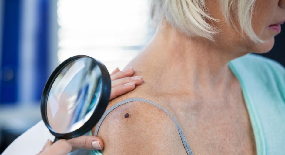 Doctor checking mole on woman's shoulder with a magnifying glass