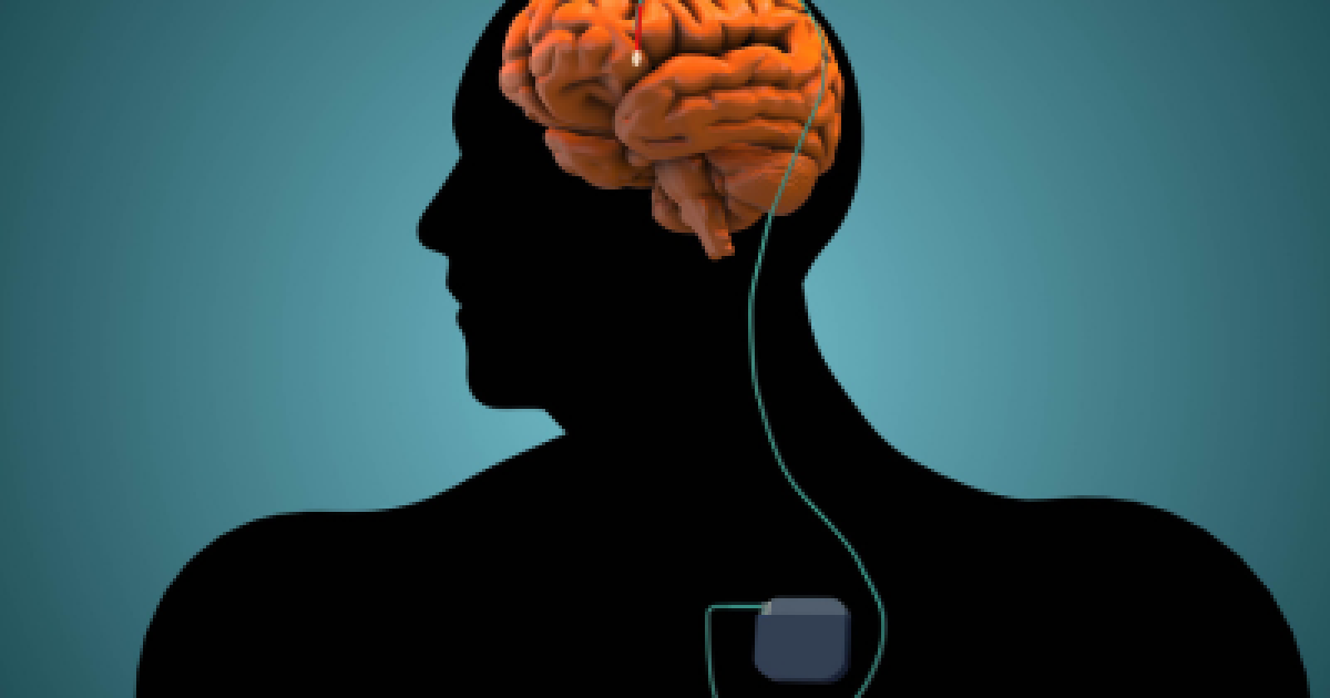 New Study Further Personalizes Deep Brain Stimulation | Parkinson's ...